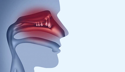 Nasal Polyps - OC ENT Clinic | Sinus Surgery | Septoplasty | Tonsillectomy  | ENT Doctor